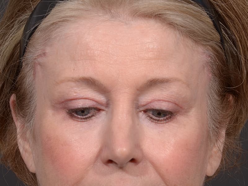 Upper Blepharoplasty Before & After Image