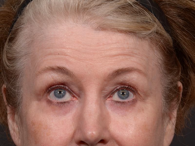 Upper Blepharoplasty Before & After Image