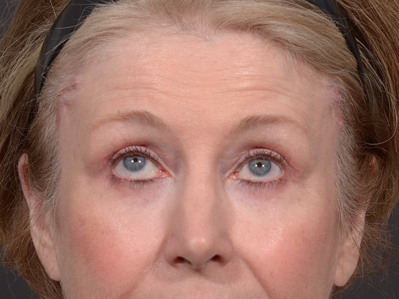 Upper Blepharoplasty Before & After Image