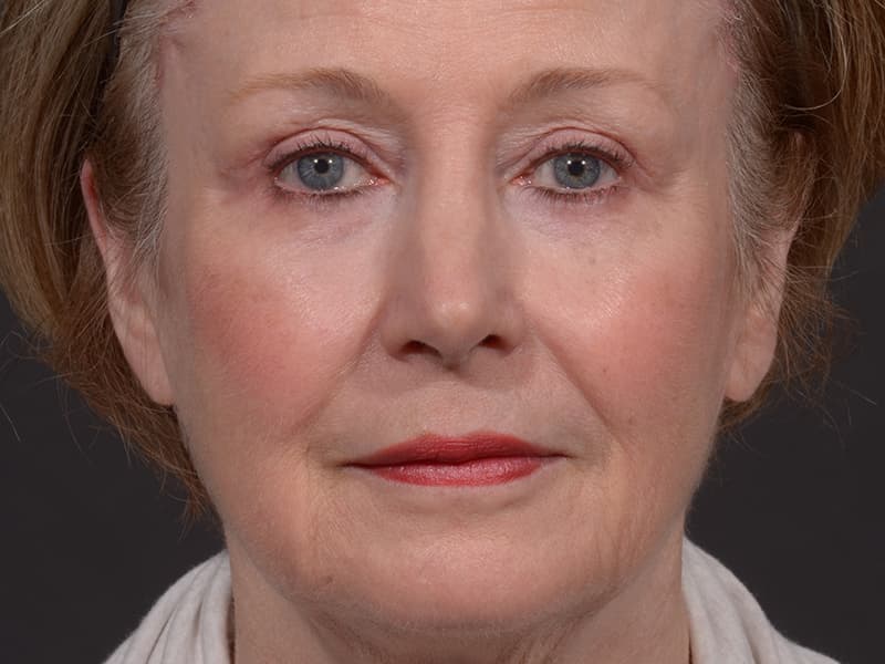 Upper Blepharoplasty Before & After Image