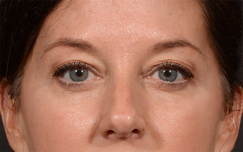 Upper Blepharoplasty Before & After Image