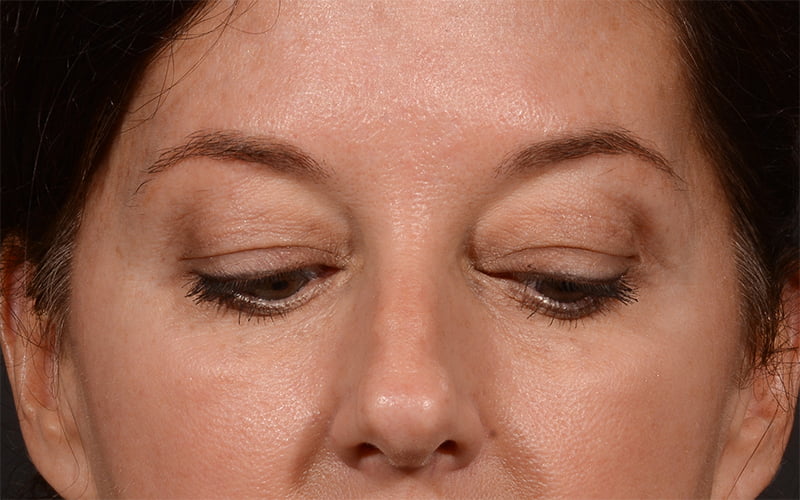Upper Blepharoplasty Before & After Image