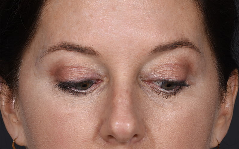 Upper Blepharoplasty Before & After Image