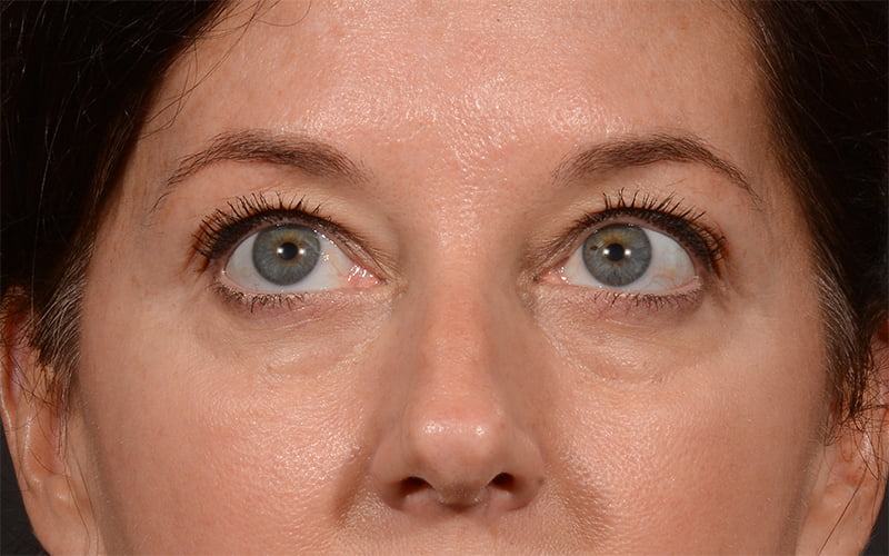 Upper Blepharoplasty Before & After Image