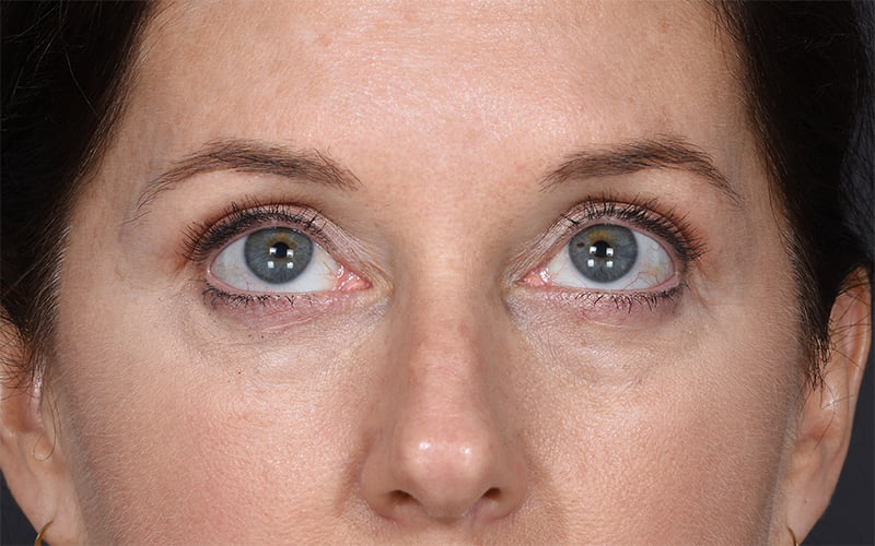 Upper Blepharoplasty Before & After Image