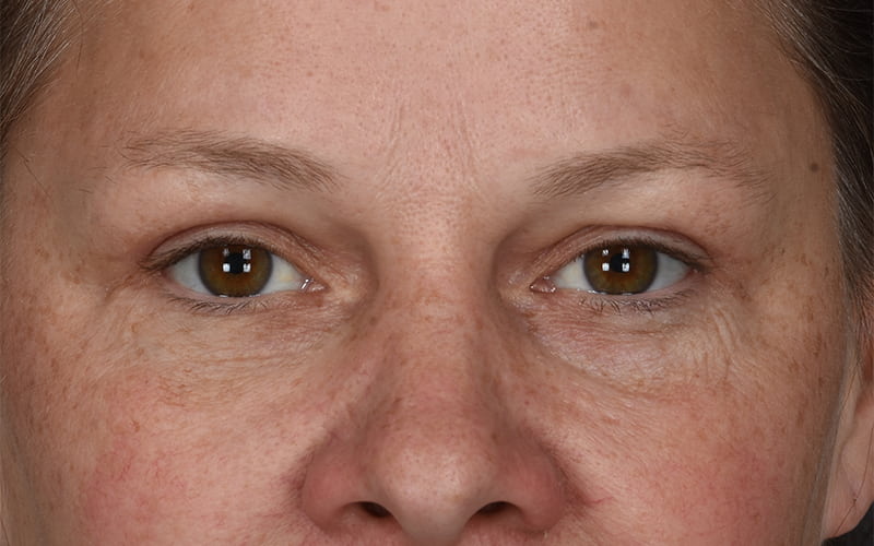 Upper Blepharoplasty Before & After Image
