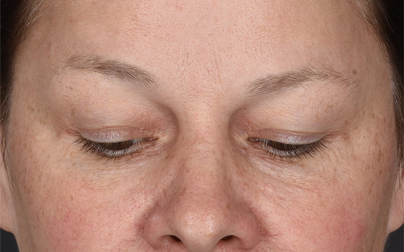 Upper Blepharoplasty Before & After Image