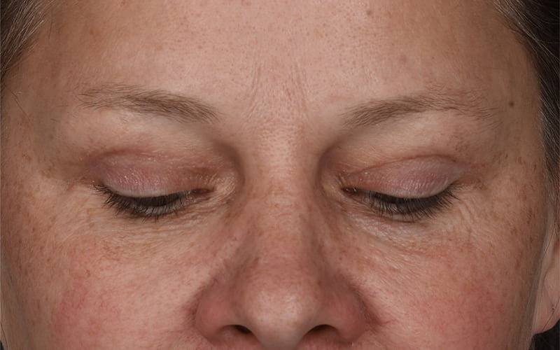 Upper Blepharoplasty Before & After Image