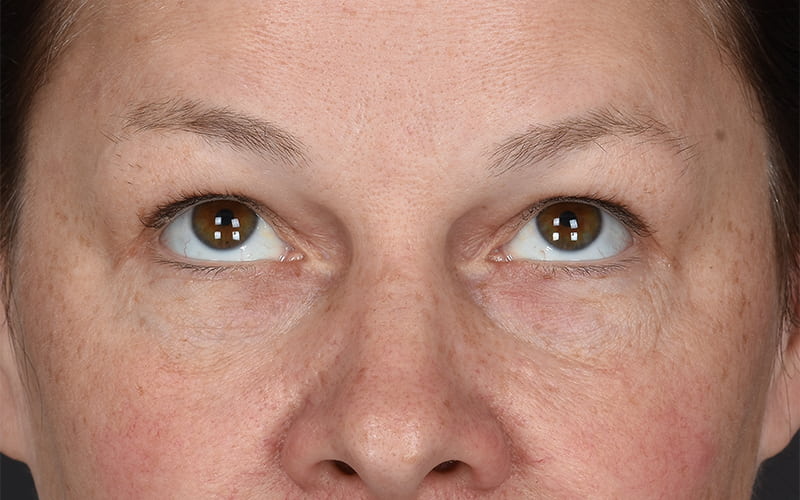 Upper Blepharoplasty Before & After Image