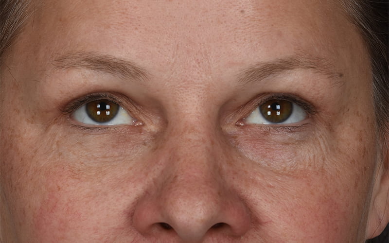 Upper Blepharoplasty Before & After Image