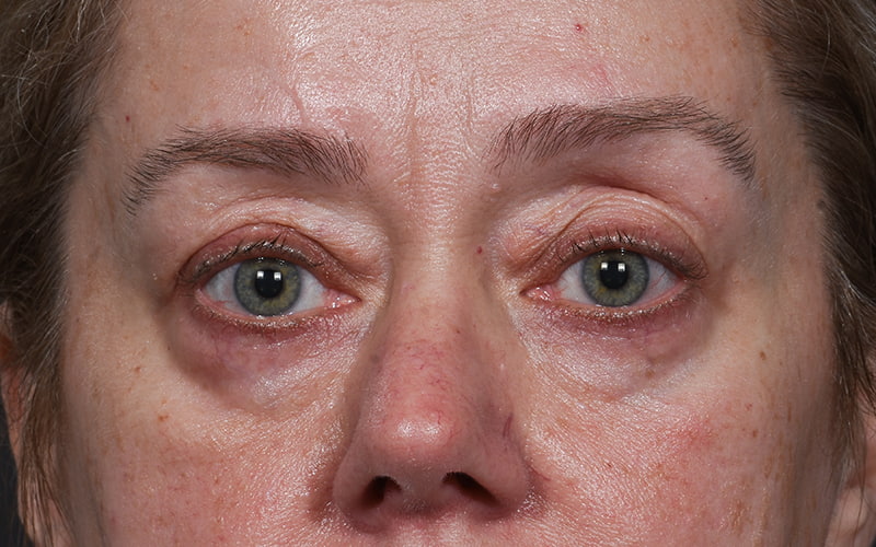Upper Blepharoplasty Before & After Image