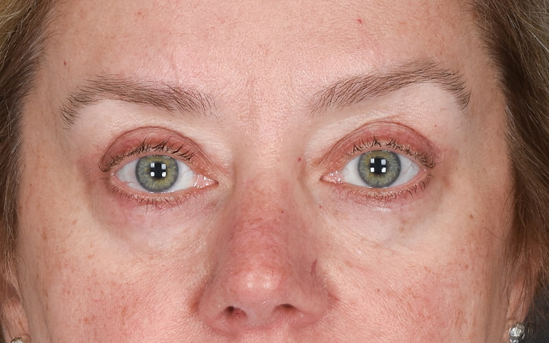 Upper Blepharoplasty Before & After Image