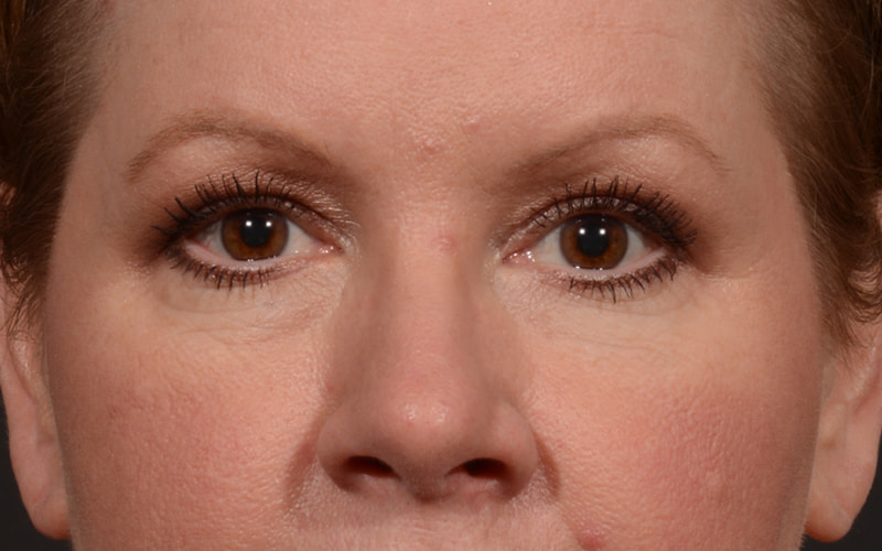 Upper Blepharoplasty Before & After Image