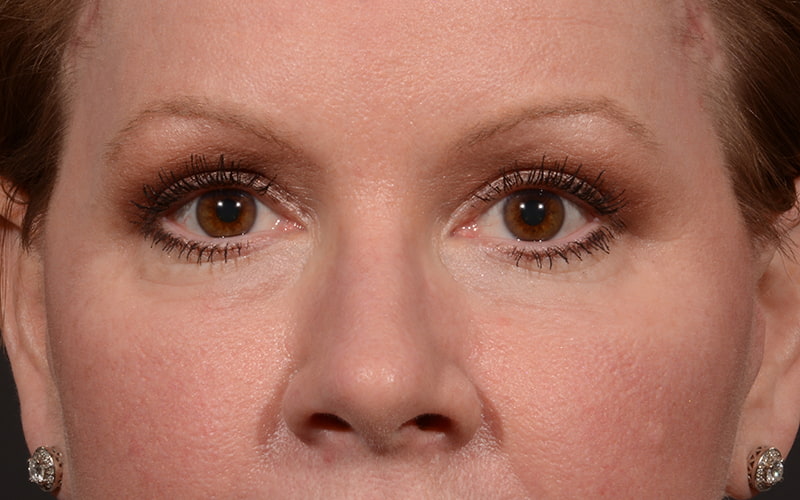 Upper Blepharoplasty Before & After Image
