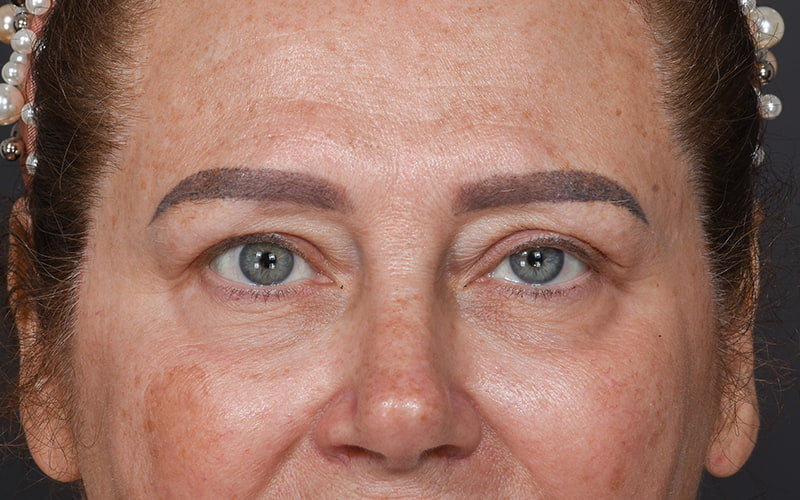 Upper Blepharoplasty Before & After Image