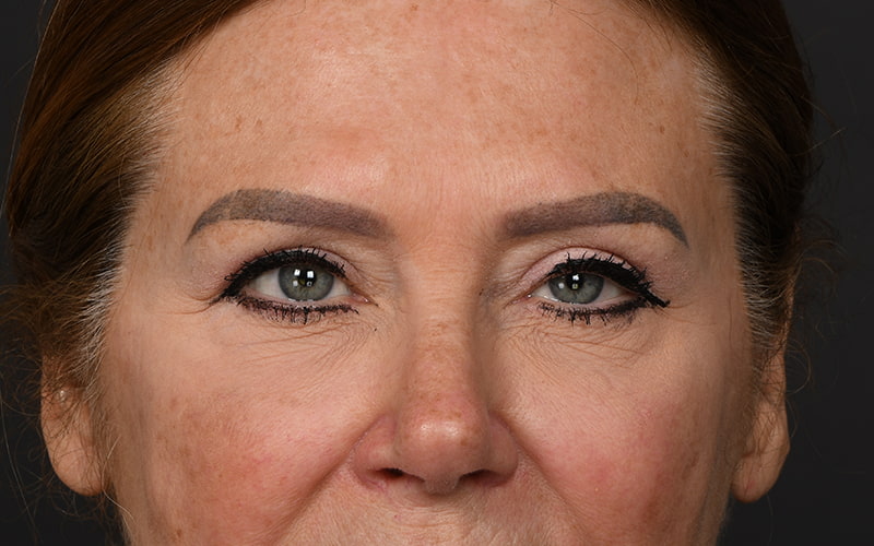 Upper Blepharoplasty Before & After Image