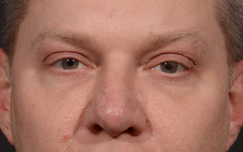Upper Blepharoplasty Before & After Image