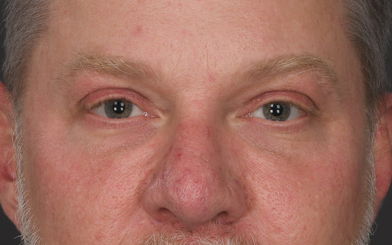 Upper Blepharoplasty Before & After Image