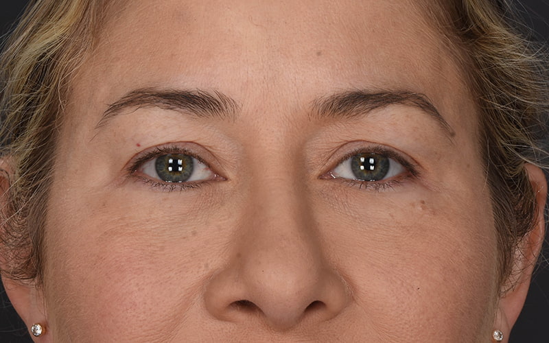 Upper Blepharoplasty Before & After Image