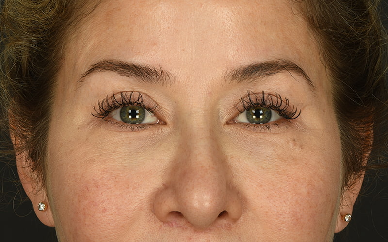 Upper Blepharoplasty Before & After Image