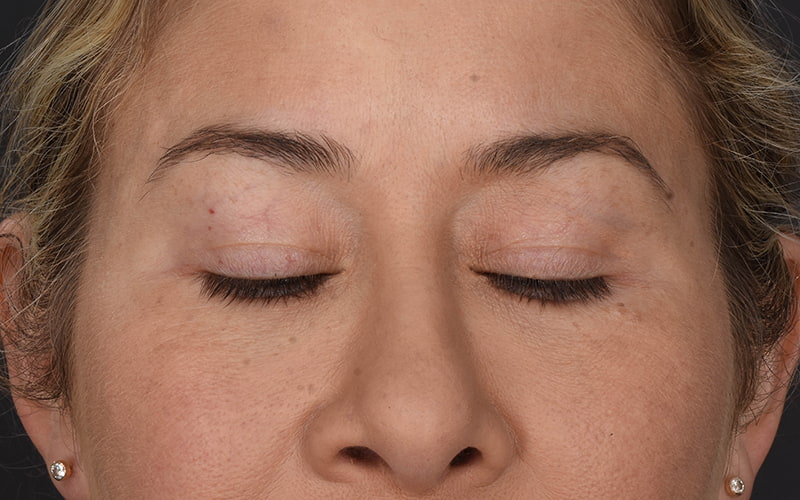 Upper Blepharoplasty Before & After Image