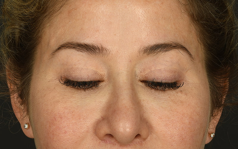 Upper Blepharoplasty Before & After Image