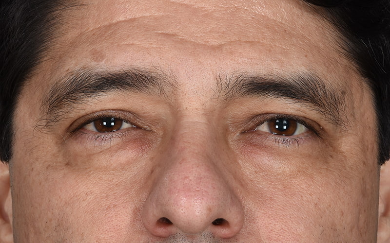 Upper Blepharoplasty Before & After Image