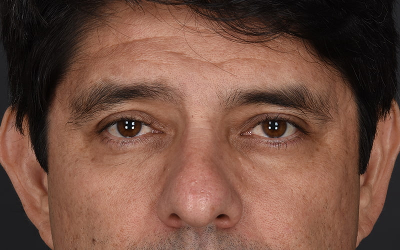 Upper Blepharoplasty Before & After Image
