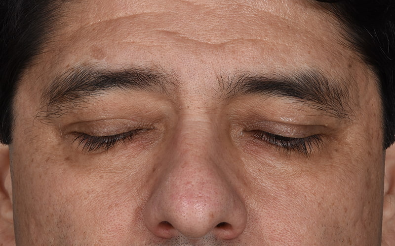 Upper Blepharoplasty Before & After Image