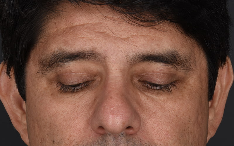 Upper Blepharoplasty Before & After Image