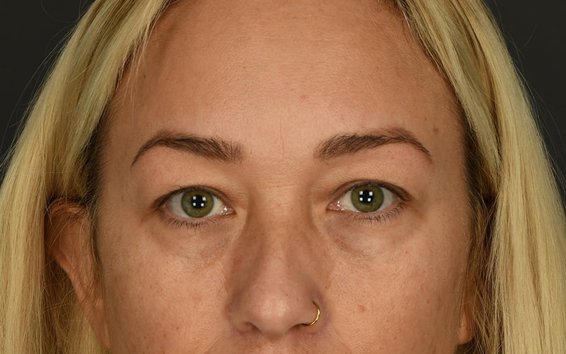 Upper Blepharoplasty Before & After Image
