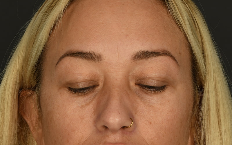 Upper Blepharoplasty Before & After Image