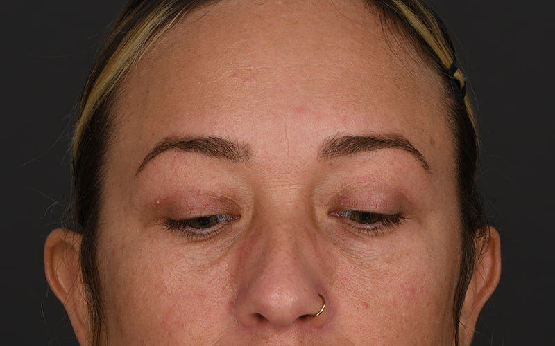 Upper Blepharoplasty Before & After Image