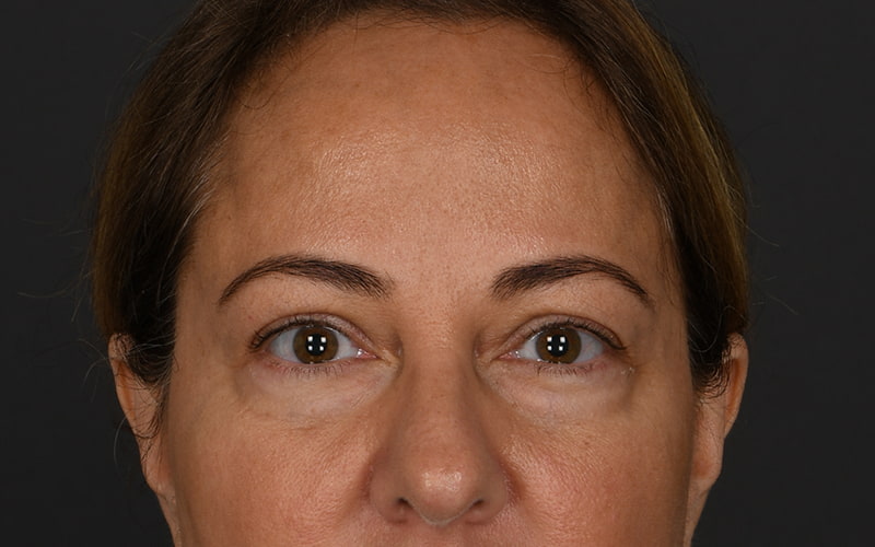 Upper Blepharoplasty Before & After Image