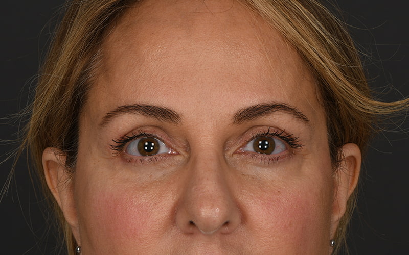 Upper Blepharoplasty Before & After Image