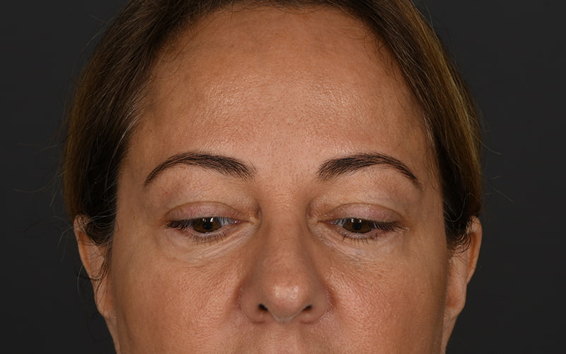 Upper Blepharoplasty Before & After Image