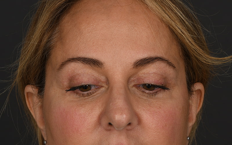 Upper Blepharoplasty Before & After Image