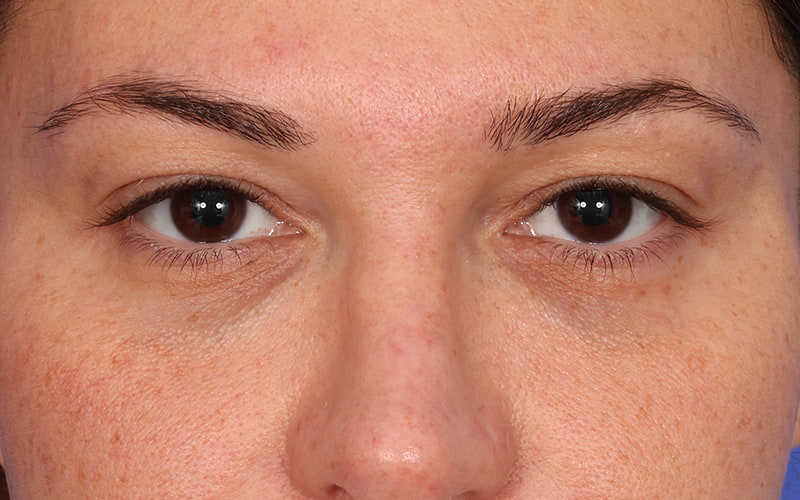 Upper Blepharoplasty Before & After Image