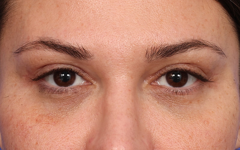 Upper Blepharoplasty Before & After Image