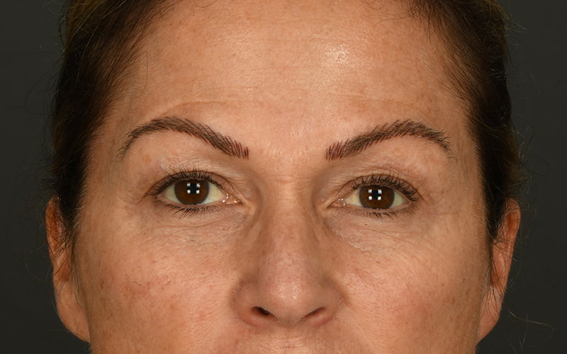 Upper Blepharoplasty Before & After Image