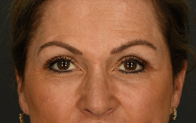 Upper Blepharoplasty Before & After Image