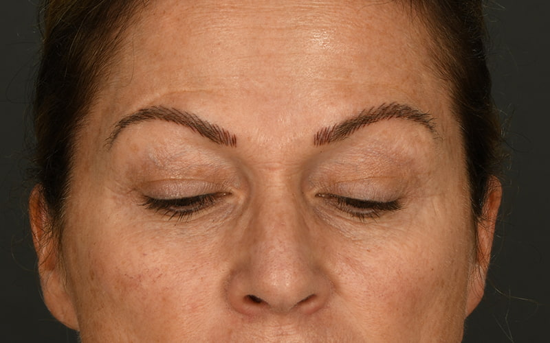 Upper Blepharoplasty Before & After Image