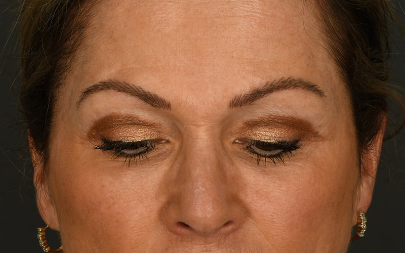 Upper Blepharoplasty Before & After Image