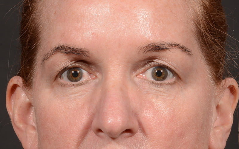 Upper Blepharoplasty Before & After Image