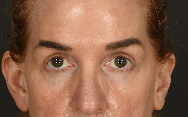 Upper Blepharoplasty Before & After Image