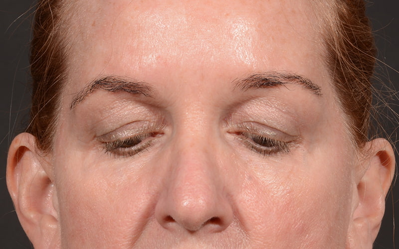 Upper Blepharoplasty Before & After Image