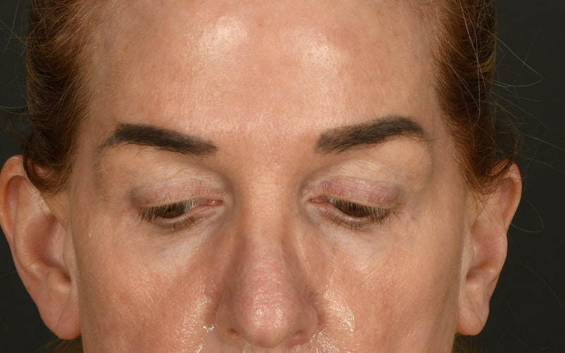 Upper Blepharoplasty Before & After Image