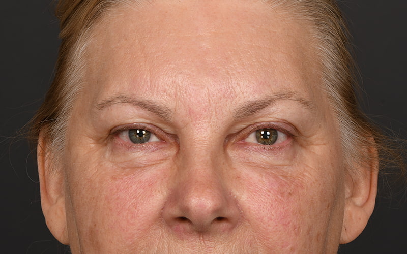 Upper Blepharoplasty Before & After Image