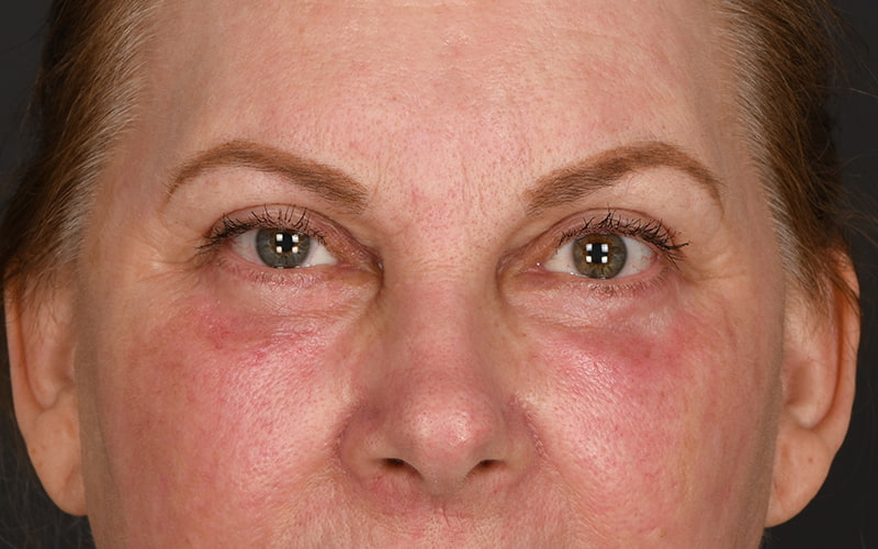 Upper Blepharoplasty Before & After Image