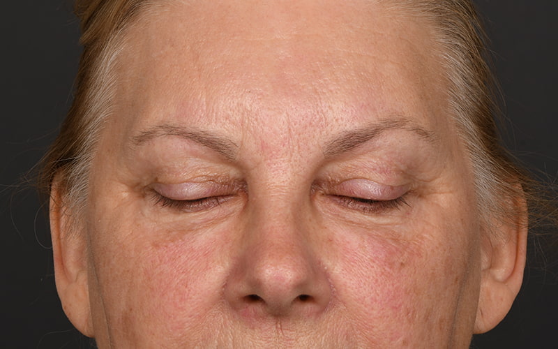 Upper Blepharoplasty Before & After Image
